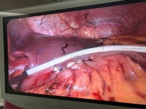 primera cirugía de pseudoquiste pancreático por vía laparoscópica en la historia del San Juan Bautista Catamarca