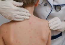 Nueva alerta por sarampión: confirman más casos en Argentina