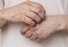 Confirman primer caso de sarampión del año en Argentina y refuerzan la vigilancia sanitaria